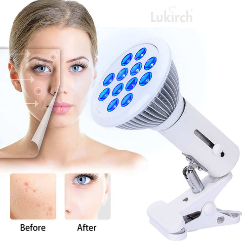 lukirch 24w blue led light therapy lamp 450nm for acne before and after contrast effect
