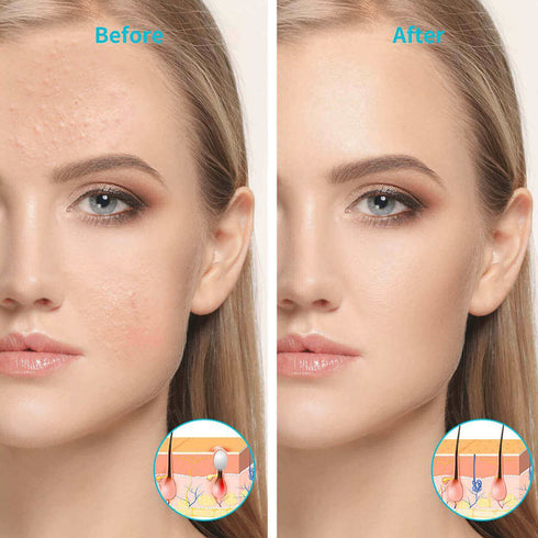 lukirch 24w blue led light therapy lamp 450nm for acne facial beauty of a women contrast effect photo