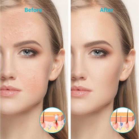 lukirch blue led light therapy lamp 54w for acne before and after contrast effect photo